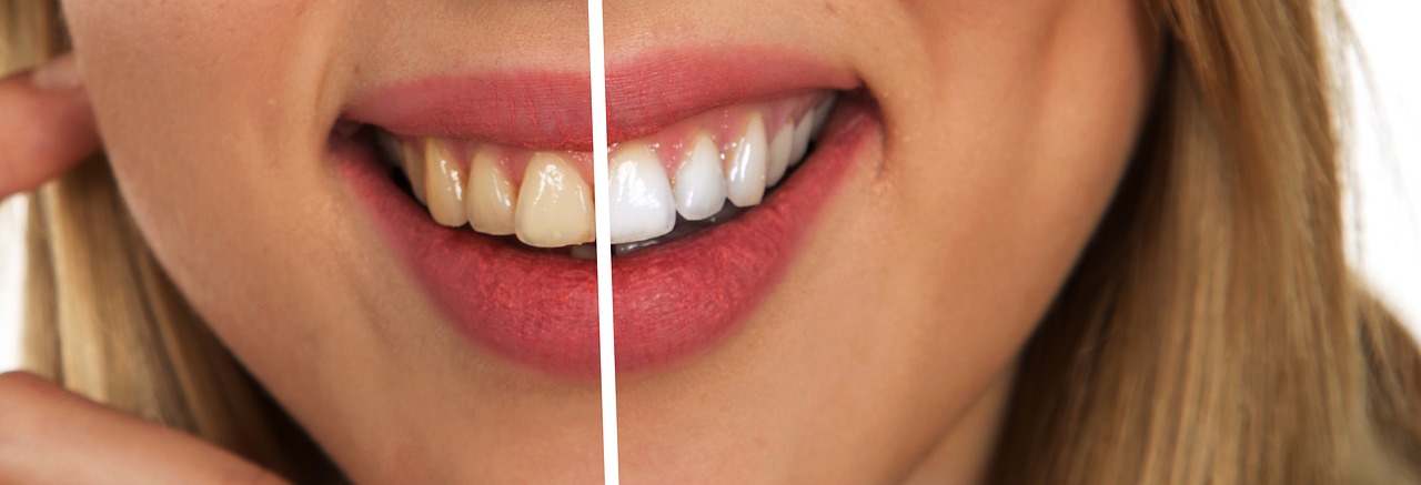 Usuwanie przebarwień z płytki zębowej – wybielanie zębów dermatic. Naturalne wybielanie zębów Kraków